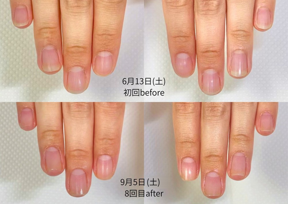 20代女性 初回と8回目の爪の比較