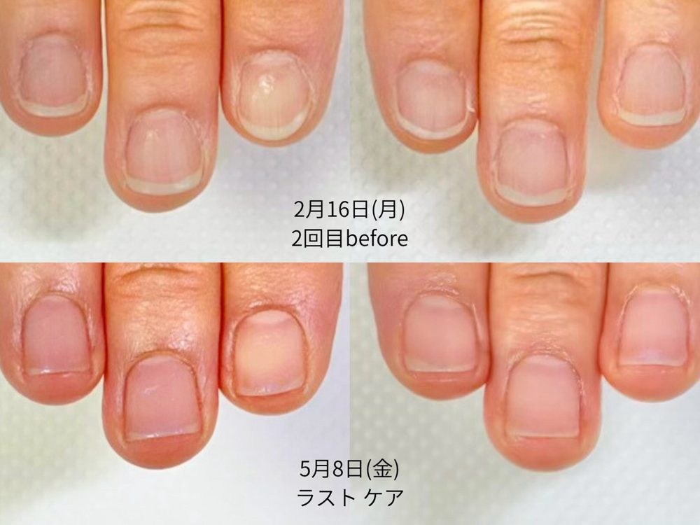 50代女性 2回目とラストケアの爪の比較
