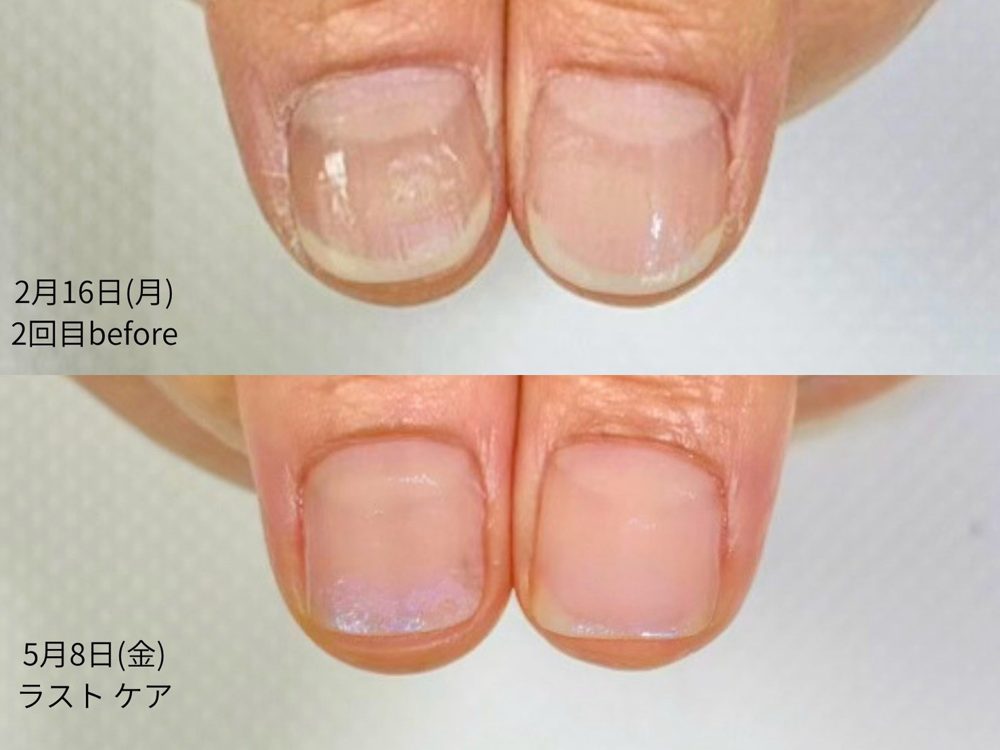 50代女性 親指の2回目とラストケアの比較